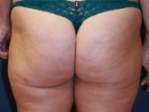 Feel Beautiful - Buttock Cellulite - Before Photo